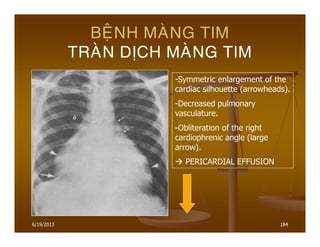 6/19/2013 184
BEÄNH MAØNG TIM
TRAØN DÒCH MAØNG TIM
-Symmetric enlargement of the
cardiac silhouette (arrowheads).
-Decreased pulmonary
vasculature.
-Obliteration of the right
cardiophrenic angle (large
arrow).
PERICARDIAL EFFUSION
 