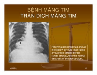 6/19/2013 185
BEÄNH MAØNG TIM
TRAØN DÒCH MAØNG TIM
Following pericardial tap and air
injection air-fluid level (large
arrow),true cardiac border
(small arrows),note the normal
thickness of the pericardium.
 