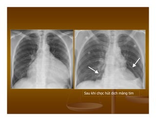 Sau khi chọc hút dịch màng tim
 