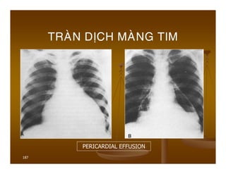 187
TRAØN DÒCH MAØNG TIM
PERICARDIAL EFFUSION
 