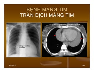 6/19/2013 188
BEÄNH MAØNG TIM
TRAØN DÒCH MAØNG TIM
 