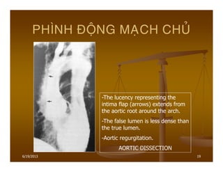 6/19/2013 19
PHÌNH ÑOÄNG MAÏCH CHUÛ
-The lucency representing the
intima flap (arrows) extends from
the aortic root around the arch.
-The false lumen is less dense than
the true lumen.
-Aortic regurgitation.
AORTIC DISSECTION
 