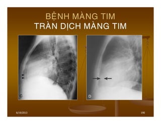 6/19/2013 190
BEÄNH MAØNG TIM
TRAØN DÒCH MAØNG TIM
 