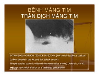 6/19/2013 191
BEÄNH MAØNG TIM
TRAØN DÒCH MAØNG TIM
INTRAVENOUS CARBON DIOXIDE INJECTION (left lateral decubitus position)
Carbon dioxide in the RA and SVC (black arrows).
The pericardiac space is widened (between white arrows).(Normal ≤ 4mm).
Either pericardial effusion or a thickened pericardium.
 