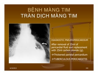 6/19/2013 193
BEÄNH MAØNG TIM
TRAØN DÒCH MAØNG TIM
DIAGNOSTIC PNEUMOPERICARDIUM
After removal of 25ml of
pericardial fluid and replacement
with 25ml carbon dioxide (g).
Thickened parietal pericardium
TUBERCULOUS PERICARDITIS
 