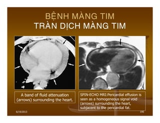 6/19/2013 195
BEÄNH MAØNG TIM
TRAØN DÒCH MAØNG TIM
A band of fluid attenuation
(arrows) surrounding the heart.
SPIN-ECHO MRI:Pericardial effusion is
seen as a homogeneous signal void
(arrows) surrounding the heart,
subjacent to the pericardial fat.
 