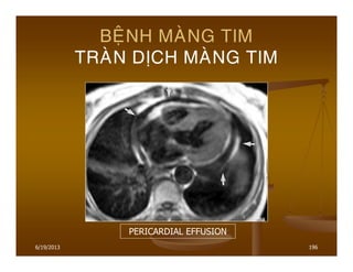 6/19/2013 196
BEÄNH MAØNG TIM
TRAØN DÒCH MAØNG TIM
PERICARDIAL EFFUSION
 