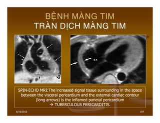 6/19/2013 197
BEÄNH MAØNG TIM
TRAØN DÒCH MAØNG TIM
SPIN-ECHO MRI:The increased signal tissue surrounding in the space
between the visceral pericardium and the external cardiac contour
(long arrows) is the inflamed parietal pericardium
TUBERCULOUS PERICARDITIS.
 