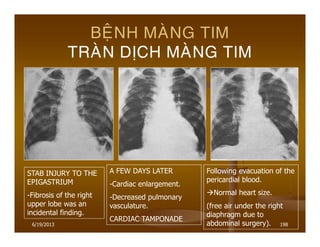 6/19/2013 198
BEÄNH MAØNG TIM
TRAØN DÒCH MAØNG TIM
STAB INJURY TO THE
EPIGASTRIUM
-Fibrosis of the right
upper lobe was an
incidental finding.
A FEW DAYS LATER
-Cardiac enlargement.
-Decreased pulmonary
vasculature.
CARDIAC TAMPONADE
Following evacuation of the
pericardial blood.
Normal heart size.
(free air under the right
diaphragm due to
abdominal surgery).
 