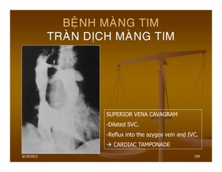 6/19/2013 199
BEÄNH MAØNG TIM
TRAØN DÒCH MAØNG TIM
SUPERIOR VENA CAVAGRAM
-Dilated SVC.
-Reflux into the azygos vein and IVC.
CARDIAC TAMPONADE
 