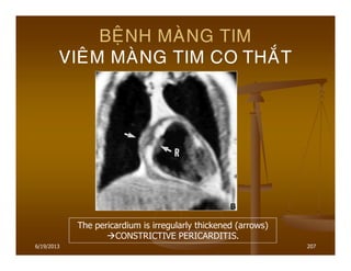 6/19/2013 207
BEÄNH MAØNG TIM
VIEÂM MAØNG TIM CO THAÉT
The pericardium is irregularly thickened (arrows)
CONSTRICTIVE PERICARDITIS.
 