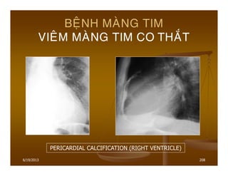 6/19/2013 208
BEÄNH MAØNG TIM
VIEÂM MAØNG TIM CO THAÉT
PERICARDIAL CALCIFICATION (RIGHT VENTRICLE)
 