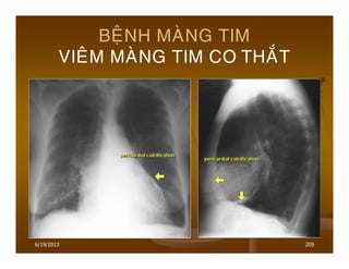 6/19/2013 209
BEÄNH MAØNG TIM
VIEÂM MAØNG TIM CO THAÉT
 