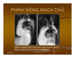 6/19/2013 21
PHÌNH ÑOÄNG MAÏCH CHUÛ
AORTIC DISSECTION:T:true lumen,F:false lumen,I:intimal
flap,LV:contrast in the LV Aortic insufficiency.
 