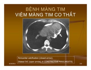6/19/2013 210
BEÄNH MAØNG TIM
VIEÂM MAØNG TIM CO THAÉT
Pericardial calcification (closed arrow).
Dilated IVC (open arrow). CONSTRICTIVE PERICARDITIS.
 