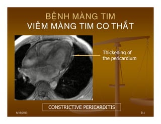 6/19/2013 211
BEÄNH MAØNG TIM
VIEÂM MAØNG TIM CO THAÉT
CONSTRICTIVE PERICARDITIS
Thickening of
the pericardium
 