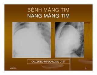 6/19/2013 214
BEÄNH MAØNG TIM
NANG MAØNG TIM
CALCIFIED PERICARDIAL CYST
 