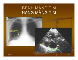 6/19/2013 215
BEÄNH MAØNG TIM
NANG MAØNG TIM
 