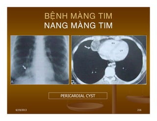 6/19/2013 216
BEÄNH MAØNG TIM
NANG MAØNG TIM
PERICARDIAL CYST
 