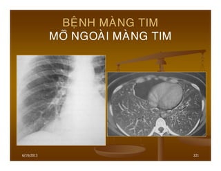 6/19/2013 221
BEÄNH MAØNG TIM
MÔÕ NGOAØI MAØNG TIM
 