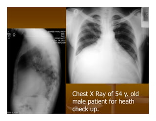 Chest X Ray of 54 y. old
male patient for heath
check up.
 