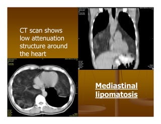 CT scan shows
low attenuation
structure around
the heart
Mediastinal
lipomatosis
 