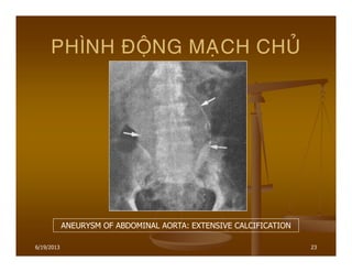 6/19/2013 23
PHÌNH ÑOÄNG MAÏCH CHUÛ
ANEURYSM OF ABDOMINAL AORTA: EXTENSIVE CALCIFICATION
 
