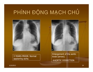 6/19/2013 24
PHÌNH ÑOÄNG MAÏCH CHUÛ
3 YEARS PRIOR: Normal
appearing aorta.
Enlargement of the aortic
knob (arrow).
AORTIC DISSECTION
 