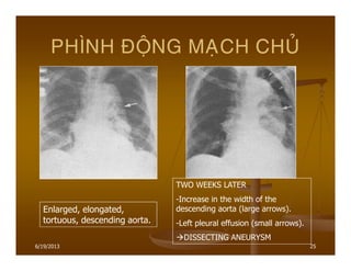 6/19/2013 25
PHÌNH ÑOÄNG MAÏCH CHUÛ
Enlarged, elongated,
tortuous, descending aorta.
TWO WEEKS LATER
-Increase in the width of the
descending aorta (large arrows).
-Left pleural effusion (small arrows).
DISSECTING ANEURYSM
 