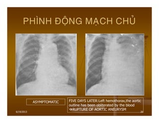 6/19/2013 26
PHÌNH ÑOÄNG MAÏCH CHUÛ
ASYMPTOMATIC FIVE DAYS LATER:Left hemothorax,the aortic
outline has been obliterated by the blood
RUPTURE OF AORTIC ANEURYSM
 