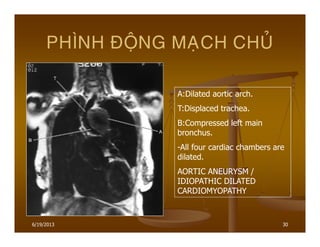 6/19/2013 30
PHÌNH ÑOÄNG MAÏCH CHUÛ
A:Dilated aortic arch.
T:Displaced trachea.
B:Compressed left main
bronchus.
-All four cardiac chambers are
dilated.
AORTIC ANEURYSM /
IDIOPATHIC DILATED
CARDIOMYOPATHY
 