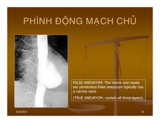 6/19/2013 32
PHÌNH ÑOÄNG MAÏCH CHUÛ
FALSE ANEURYSM: The intima and media
are penetrated.False aneurysm typically has
a narrow neck.
(TRUE ANEURYSM: contain all three layers).
 