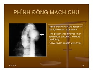 6/19/2013 34
PHÌNH ÑOÄNG MAÏCH CHUÛ
-False aneurysm in the region of
the ligamentum arteriosum.
-The patient was involved in an
automobile accident 3 months
previously.
TRAUMATIC AORTIC ANEURYSM
 