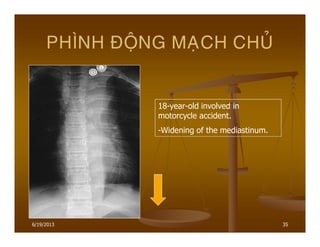6/19/2013 35
PHÌNH ÑOÄNG MAÏCH CHUÛ
18-year-old involved in
motorcycle accident.
-Widening of the mediastinum.
 
