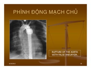 6/19/2013 36
PHÌNH ÑOÄNG MAÏCH CHUÛ
RUPTURE OF THE AORTA
WITH FALSE ANEURYSM.
 