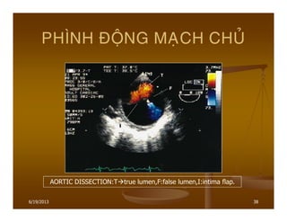 6/19/2013 38
PHÌNH ÑOÄNG MAÏCH CHUÛ
AORTIC DISSECTION:T true lumen,F:false lumen,I:intima flap.
 