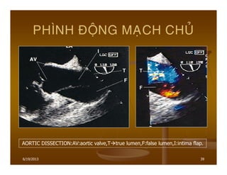 6/19/2013 39
PHÌNH ÑOÄNG MAÏCH CHUÛ
AORTIC DISSECTION:AV:aortic valve,T true lumen,F:false lumen,I:intima flap.
 