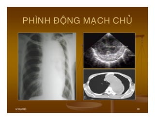 6/19/2013 40
PHÌNH ÑOÄNG MAÏCH CHUÛ
 