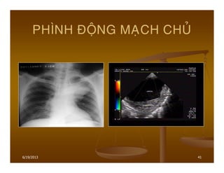 6/19/2013 41
PHÌNH ÑOÄNG MAÏCH CHUÛ
 