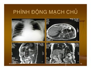 6/19/2013 42
PHÌNH ÑOÄNG MAÏCH CHUÛ
 