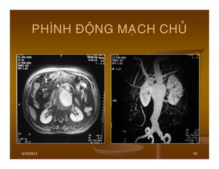 6/19/2013 43
PHÌNH ÑOÄNG MAÏCH CHUÛ
 