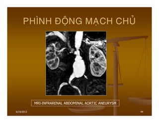 6/19/2013 44
PHÌNH ÑOÄNG MAÏCH CHUÛ
MRI-INFRARENAL ABDOMINAL AORTIC ANEURYSM
 