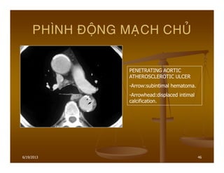 6/19/2013 46
PHÌNH ÑOÄNG MAÏCH CHUÛ
PENETRATING AORTIC
ATHEROSCLEROTIC ULCER
-Arrow:subintimal hematoma.
-Arrowhead:displaced intimal
calcification.
 
