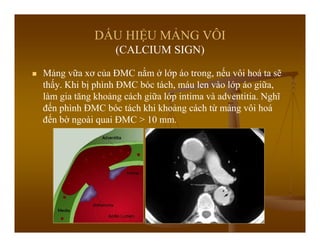 DẤU HIỆU MẢNG VÔI
(CALCIUM SIGN)
Mảng vữa xơ của ĐMC nằm ở lớp áo trong, nếu vôi hoá ta sẽ
thấy. Khi bị phình ĐMC bóc tách, máu len vào lớp áo giữa,
làm gia tăng khoảng cách giữa lớp intima và adventitia. Nghĩ
đến phình ĐMC bóc tách khi khoảng cách từ mảng vôi hoá
đến bờ ngoài quai ĐMC > 10 mm.
 