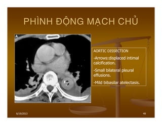 6/19/2013 49
PHÌNH ÑOÄNG MAÏCH CHUÛ
AORTIC DISSECTION
-Arrows:displaced intimal
calcification.
-Small bilateral pleural
effusions.
-Mild bibasilar atelectasis.
 