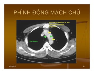 6/19/2013 51
PHÌNH ÑOÄNG MAÏCH CHUÛ
 