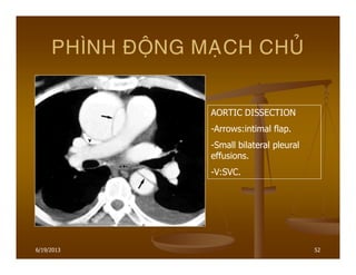 6/19/2013 52
PHÌNH ÑOÄNG MAÏCH CHUÛ
AORTIC DISSECTION
-Arrows:intimal flap.
-Small bilateral pleural
effusions.
-V:SVC.
 