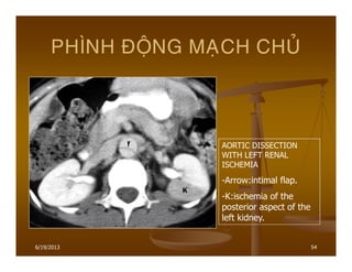 6/19/2013 54
PHÌNH ÑOÄNG MAÏCH CHUÛ
AORTIC DISSECTION
WITH LEFT RENAL
ISCHEMIA
-Arrow:intimal flap.
-K:ischemia of the
posterior aspect of the
left kidney.
 