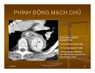 6/19/2013 55
PHÌNH ÑOÄNG MAÏCH CHUÛ
RUPTURED AORTIC
DISSECTION
-Arrowheads:intimal flap.
-Arrow:nasogastric tube.
-Hemorrhage infiltrates
the soft tissues around the
descending aorta.
 