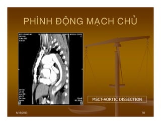 6/19/2013 56
PHÌNH ÑOÄNG MAÏCH CHUÛ
MSCT-AORTIC DISSECTION
 